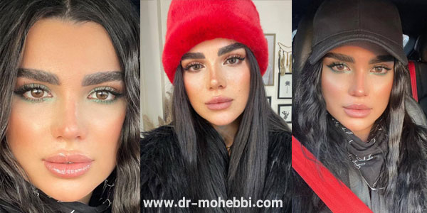 تصاویر نمونه کار جراح بینی تهران دکتر محبی