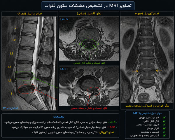 بررسی MRI ستون فقرات برای تشخیص مشکلات عصبی و دیسک