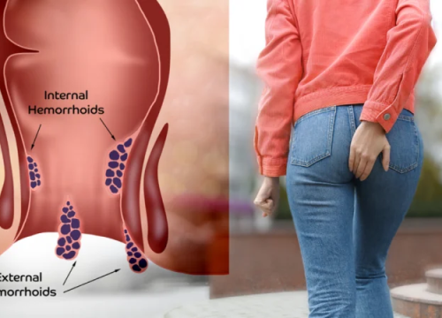 درمان قطعی بواسیر با لیزر؛  پایان دردهای همیشگی در بیماری های نشیمنگاهی